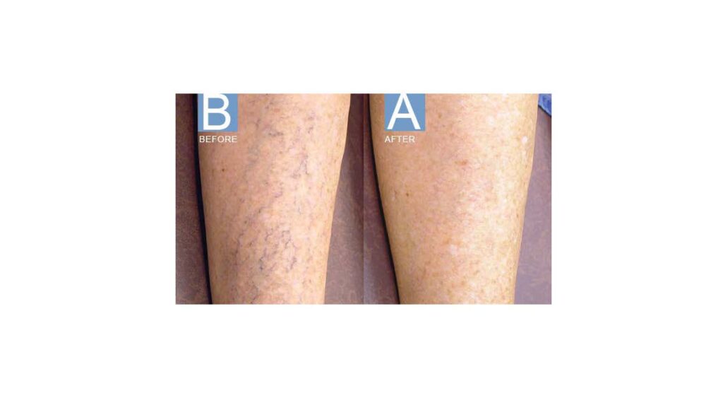 Sclerotherapy case #5002