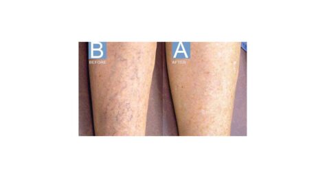 Sclerotherapy case #5002