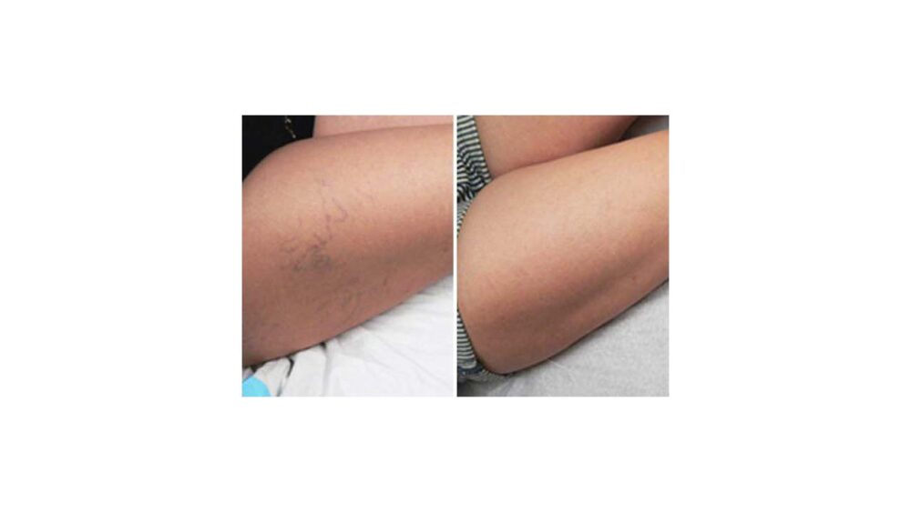 Sclerotherapy case #5000