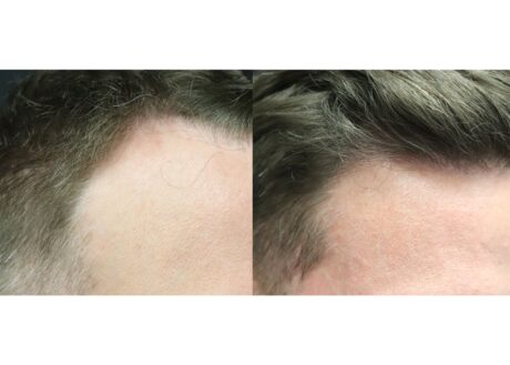 Hair Transplant case #5204