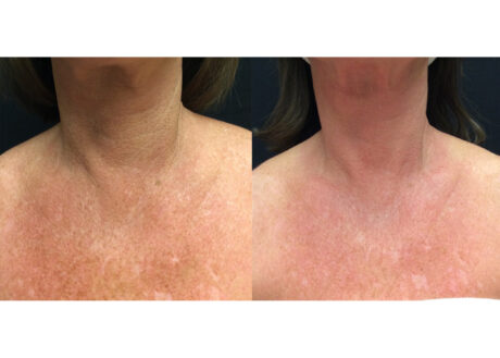 IPL Photofacial case #5132