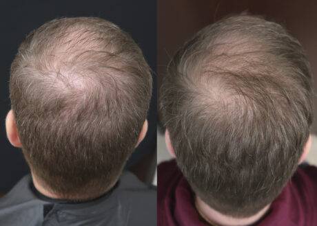 PRP for Hair Restoration case #5026