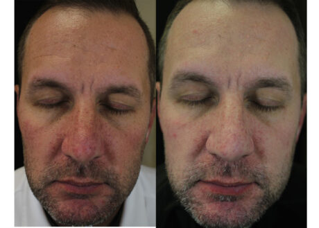 IPL Photofacial case #5136