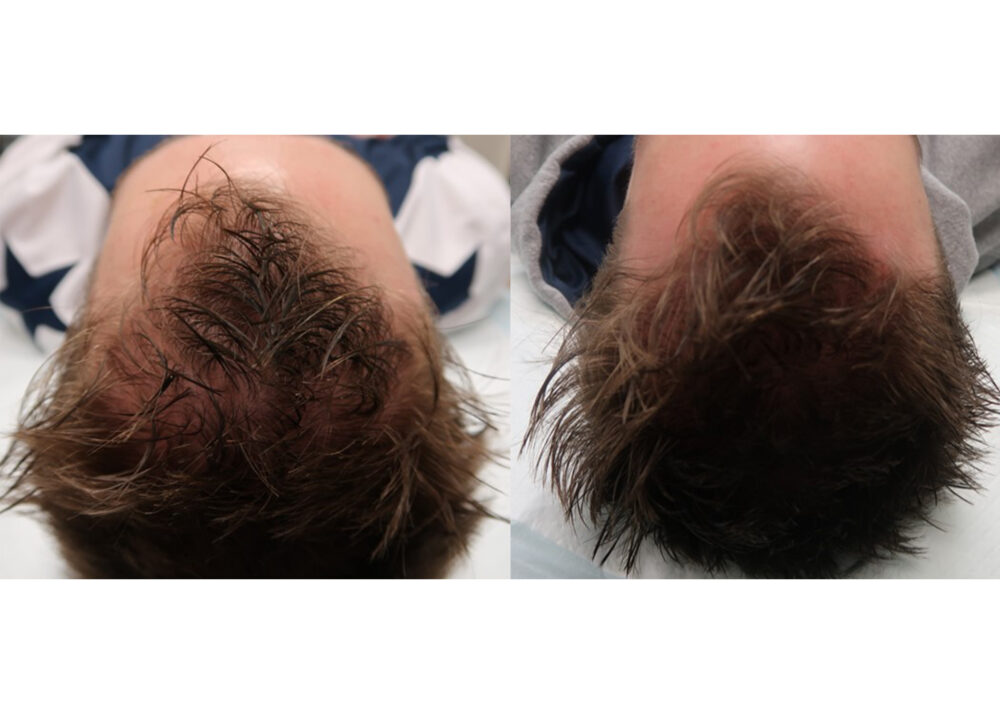 PRP for Hair Restoration case #5015