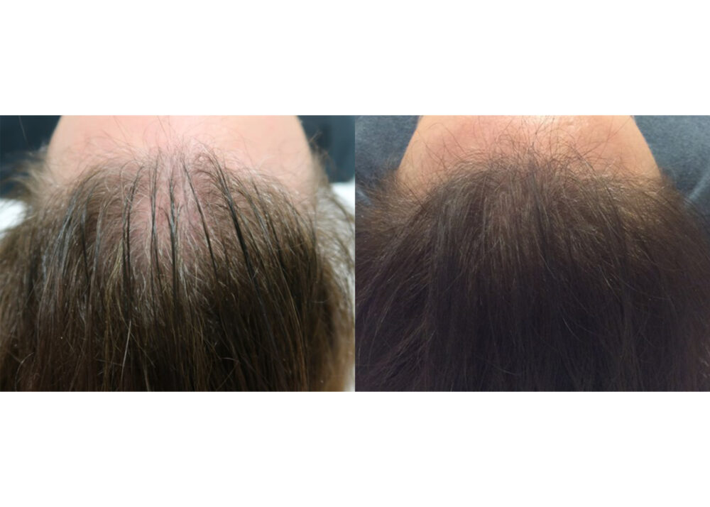 PRP for Hair Restoration case #5013