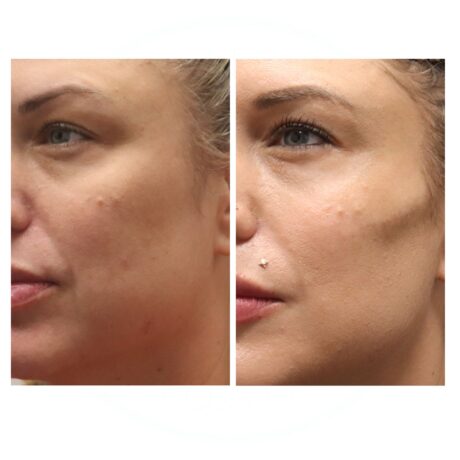 Cheek Filler case #5269