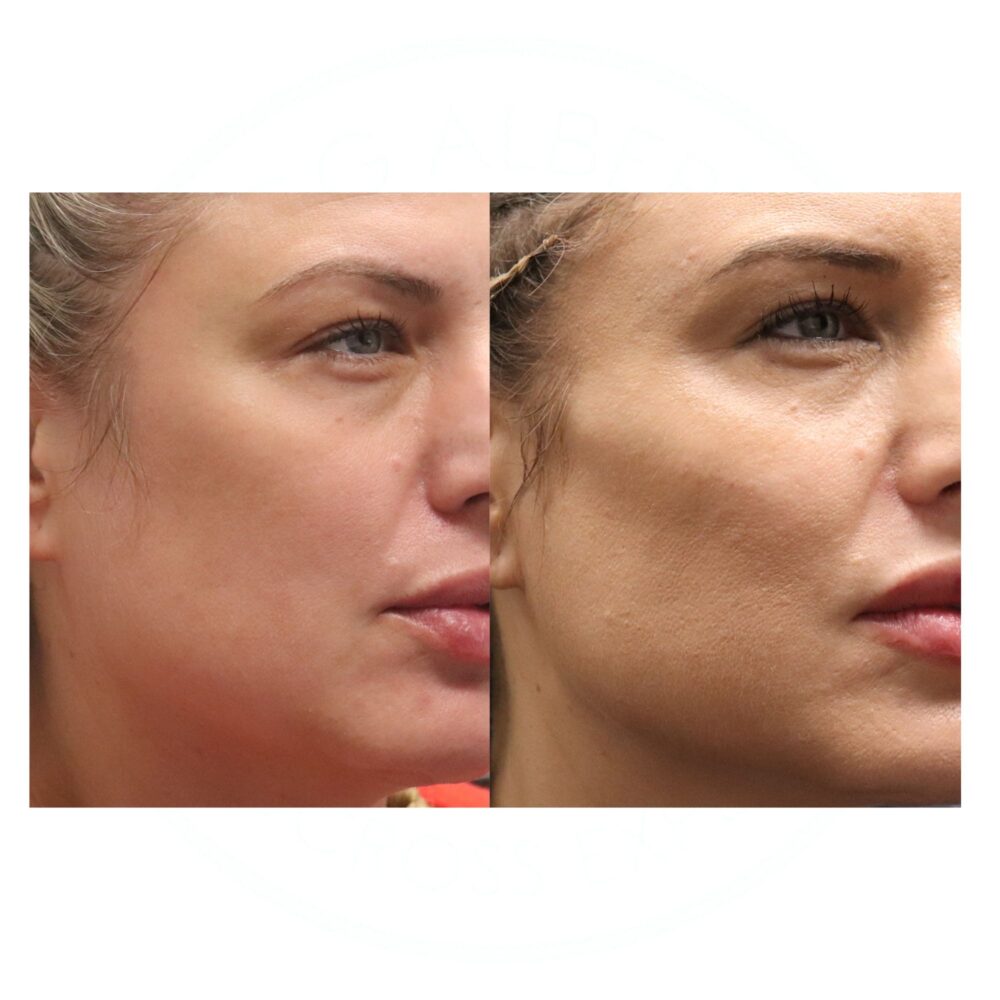 Cheek Filler case #5260