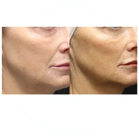 Cheek Filler case #5271