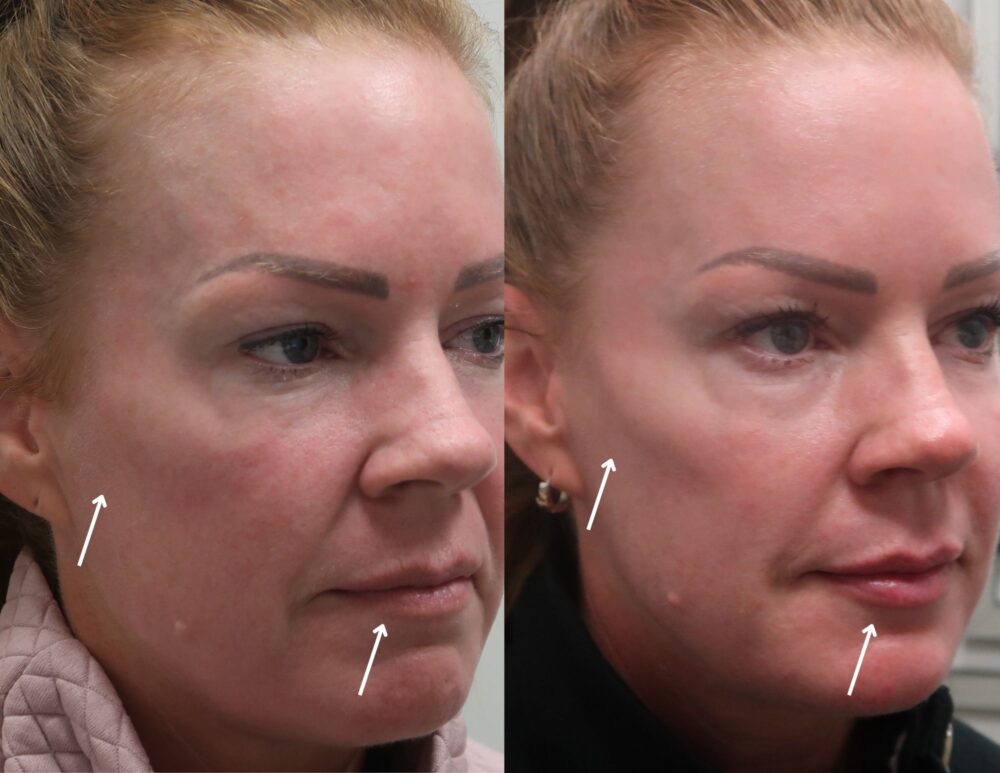 Cheek Filler case #5281