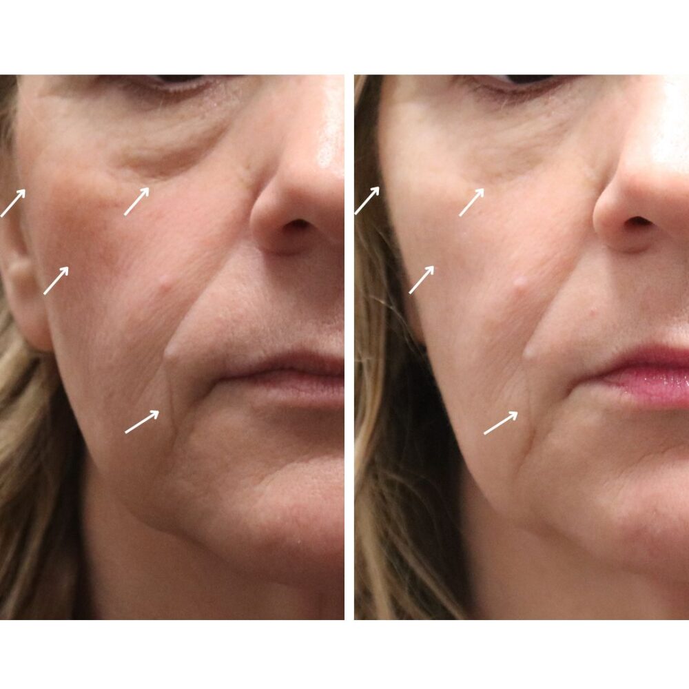 Cheek Filler case #5283