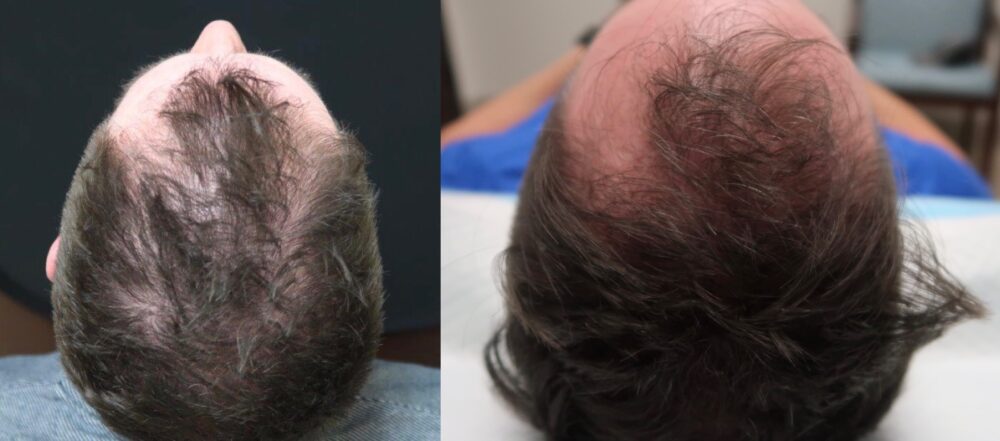 PRP for Hair Restoration case #5022