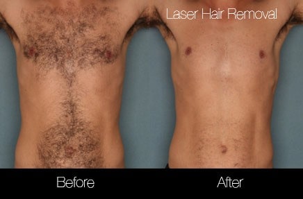 Laser Hair Removal case #5126