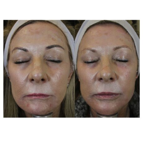 IPL Photofacial case #5143