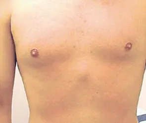 chest-after-295×250-1