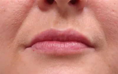 fl1-after-400×250-1