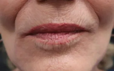 lf2-after-400×250-1