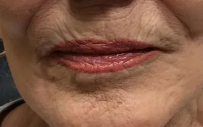 lf2-before-400×250-1