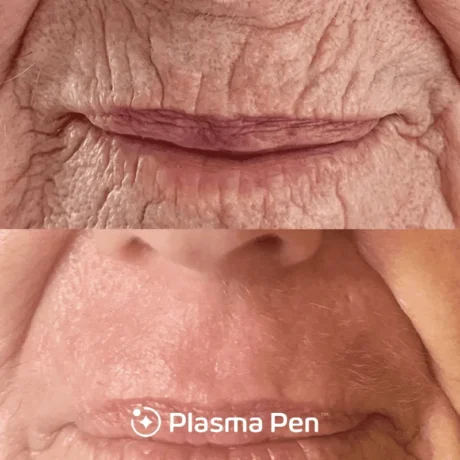 Plasma Pen case #7808