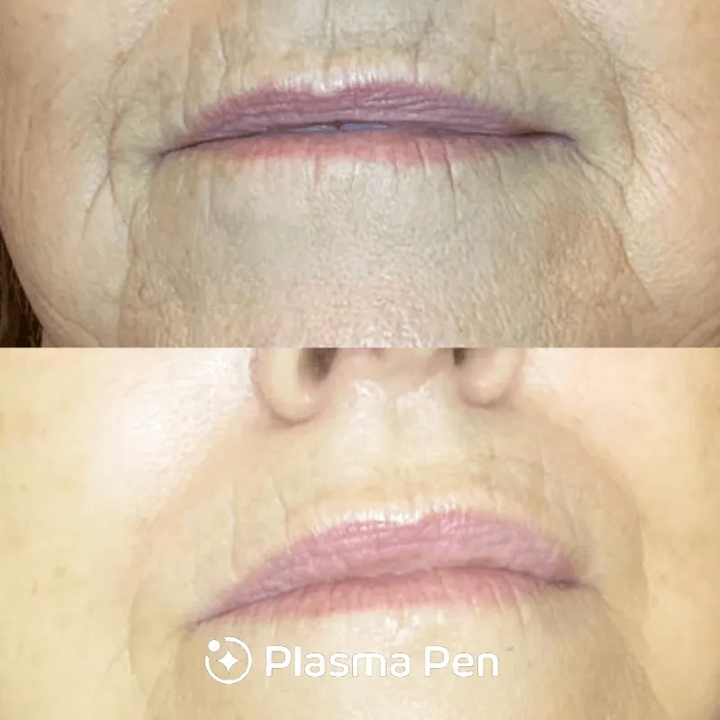 Plasma Pen case #7806