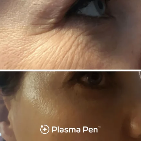 Plasma Pen case #8036