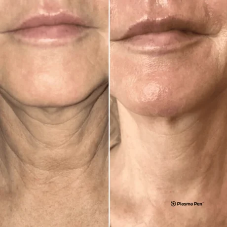 Plasma Pen case #8090