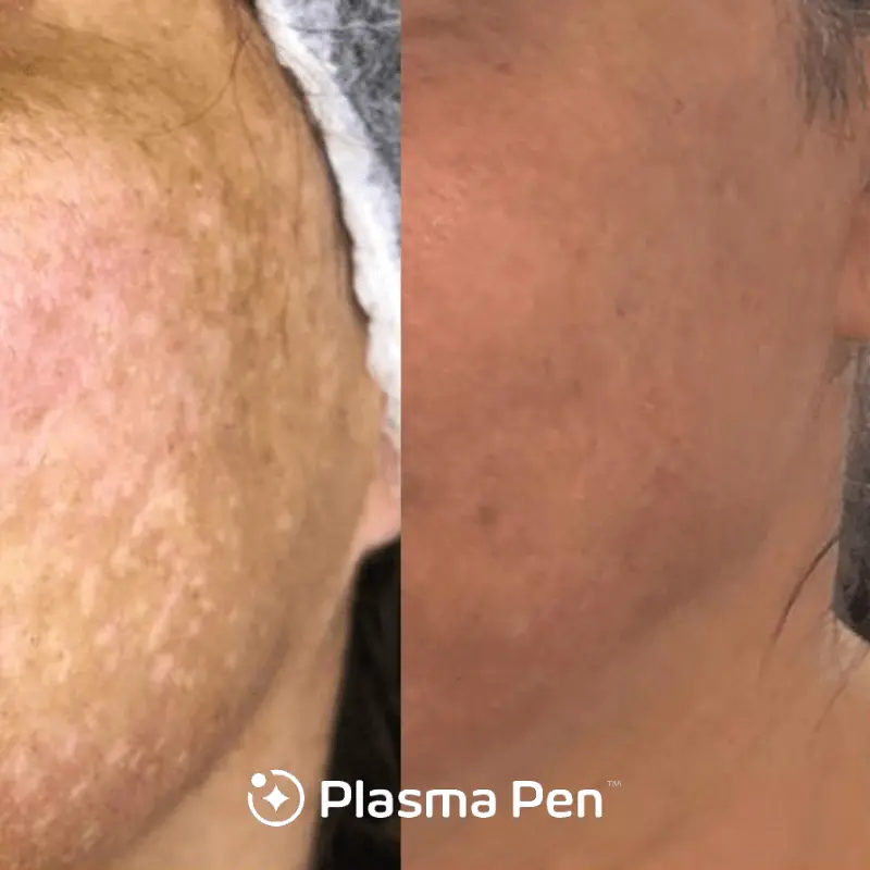 Plasma Pen case #7872