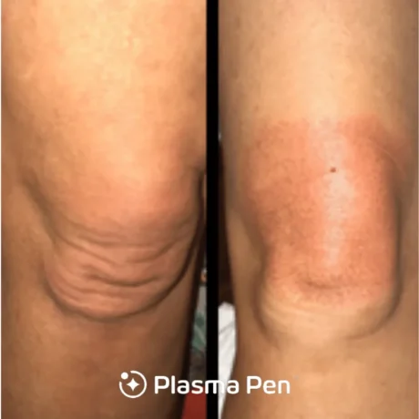 Plasma Pen case #7884
