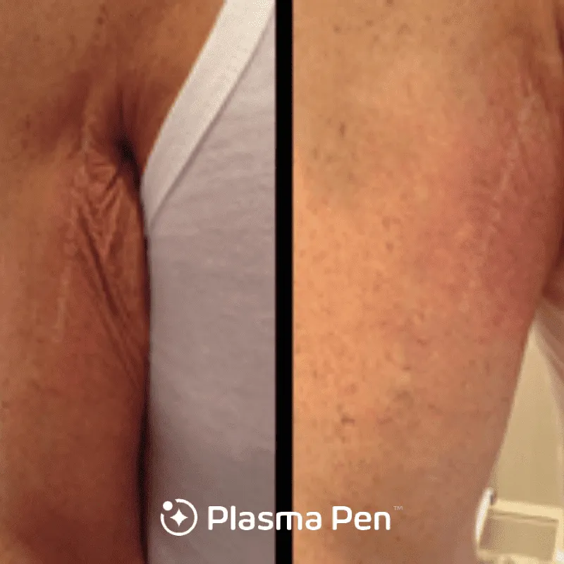 Plasma Pen case #7886