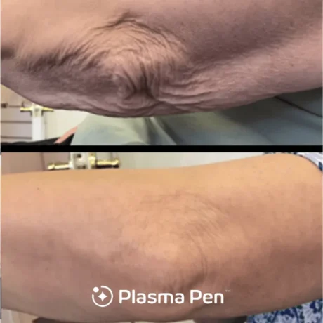 Plasma Pen case #7888