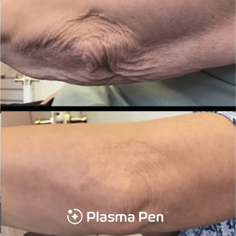 Plasma Pen case #7888