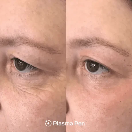 Plasma Pen case #7998